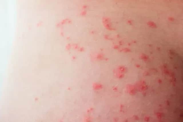 Pryszcze na pośladkach? Poznaj przyczyny i skuteczne rozwiązania