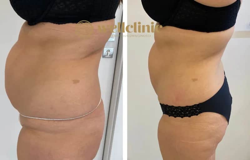 Liposukcja: Modelowanie sylwetki czy to rozwiązanie dla Ciebie?