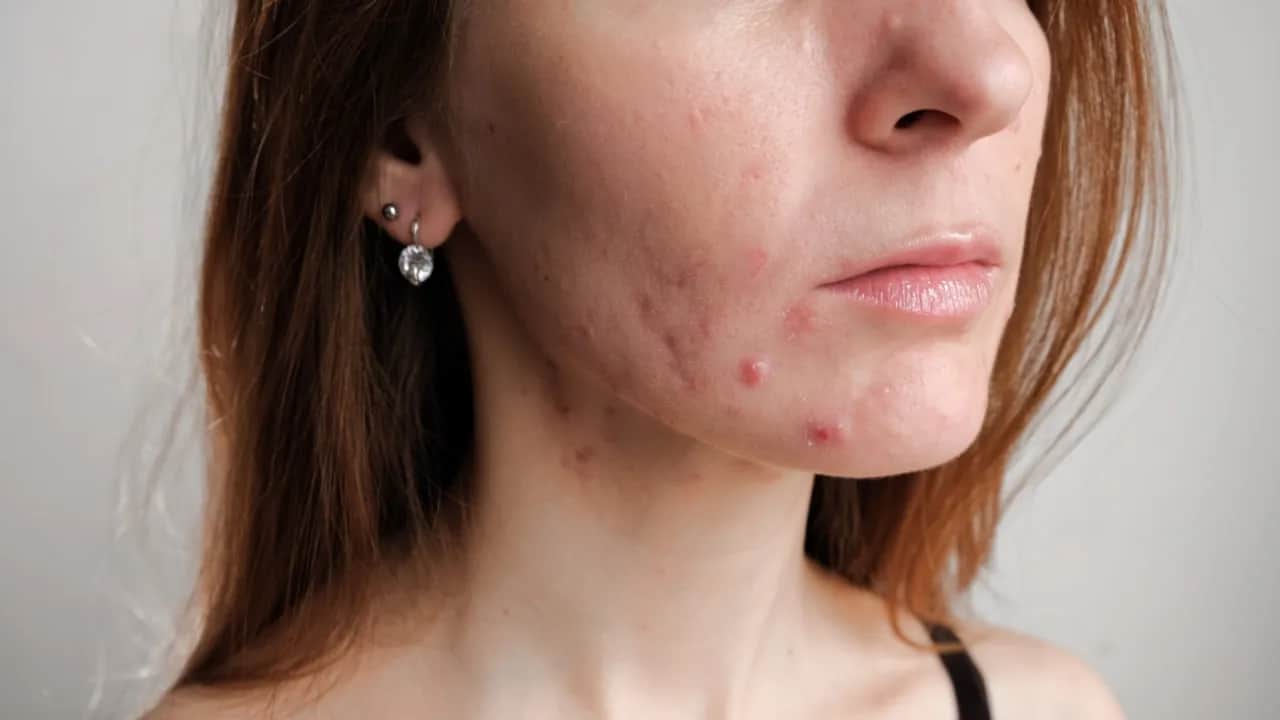 Blizny po pryszczach? Skuteczne metody na gładką cerę i jak im zapobiegać