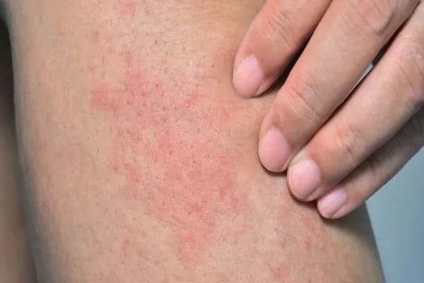 Masz krostki na nogach? Oto przyczyny i jak mieć gładką skórę