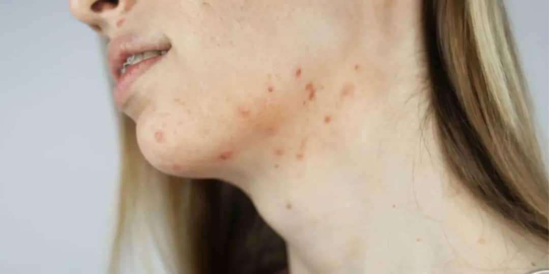 Pryszcze na brodzie: Czy to hormony? Poznaj 7 przyczyn i leczenie